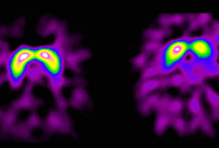 Die Abbildung zeigt rechts eine gesunde Kontrollperson und links einen Patienten mit rechtsbetonter Parkinsonkrankheit. Beim Parkinsonpatienten findet sich eine geringere Anreicherung des Signals links. (Foto: Medizinische Universität Innsbruck)